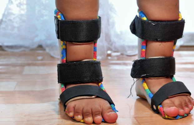 A close-up view of a child's lower legs wearing fitted leg orthoses.