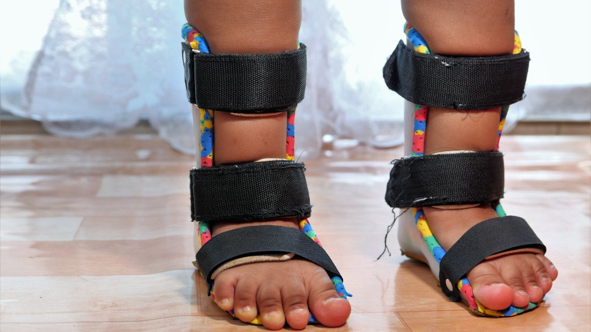A close-up view of a child's lower legs wearing fitted leg orthoses.